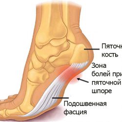 Ударно-волновая терапия пяточной шпоры