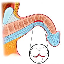 Лечение болезни Пейрони ударно-волновой терапией