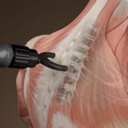 Ударно-волновая терапия позвоночника при грыже