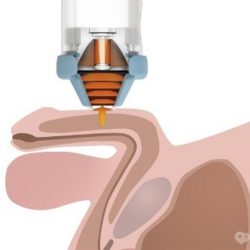 Ударно-волновая терапия в урологии